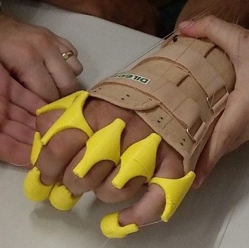 assembled dynamic orthosis 